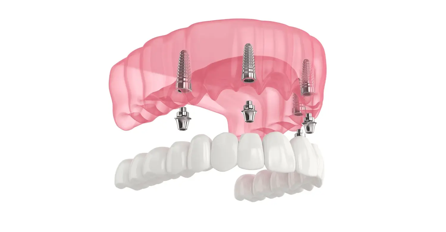 all on 4 dental implants abroad 2